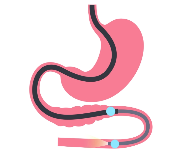 Double balloon enteroscopy