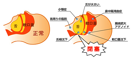 主な原因